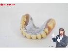 入れ歯 総重量:約39.1g 金パラ 銀パラ 義歯 歯科技工の詳細ページを開く